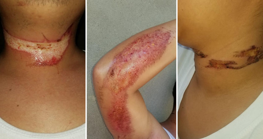 Sufrieron lesiones en varias partes del cuerpo. Foto: José Enrique Ortega/Radio ABC Stereo