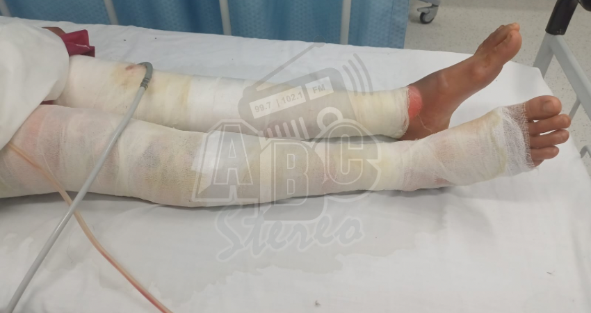 Cuatro personas resultaron con quemaduras en varias partes de su cuerpo debido a la explosión de un gas que había sido recién instalado. Entre las afectadas está una menor de 14 años de edad.