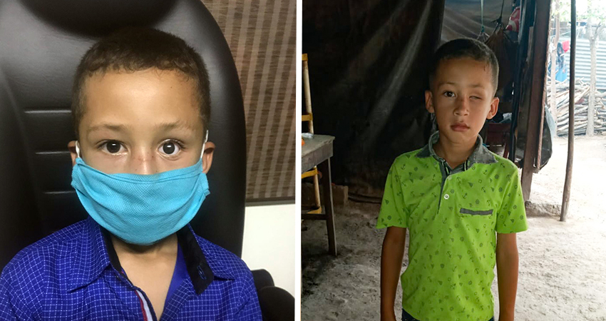 Elkin Noel antes y después de su prótesis. Foto: Cortesía/Radio ABC Stereo